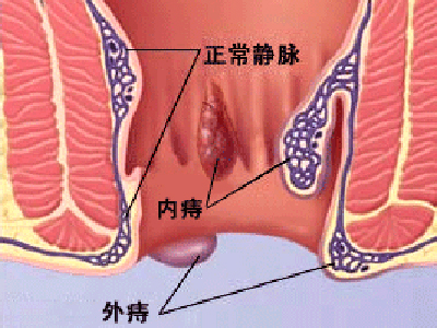 最新痔瘡治療方法及其進(jìn)展概覽